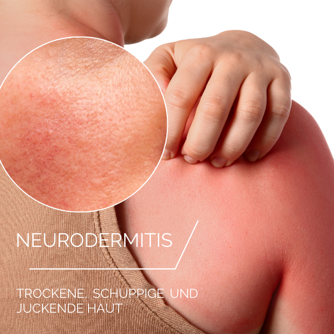 Neurodermitis
