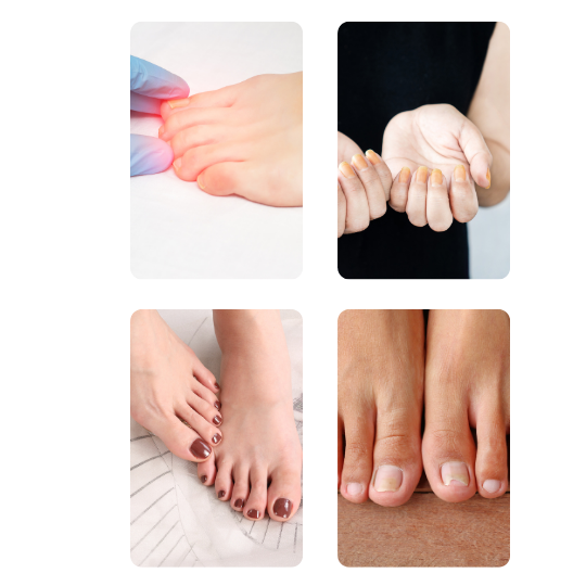 Was hilft gegen Nagelpilz