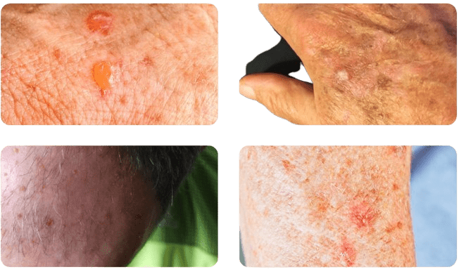 aktinische Keratose Körpersstellen